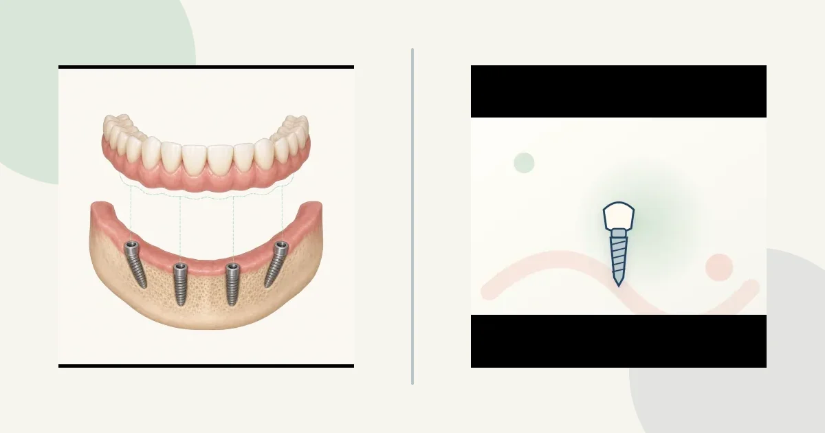 Full-arch implant count comparison graphic