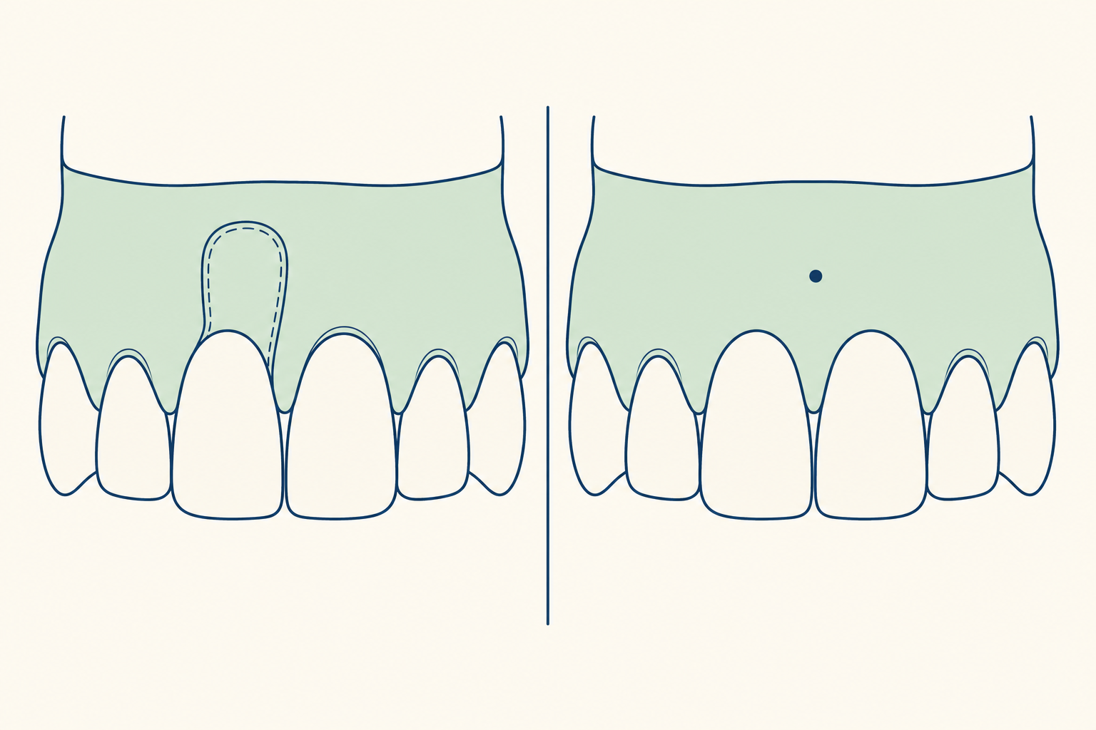 Illustrative diagram: gum grafting vs pinhole surgical technique