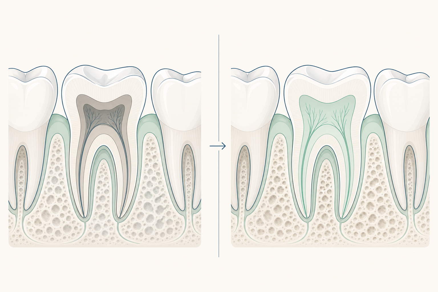 Illustrative diagram: Pulp Degeneration