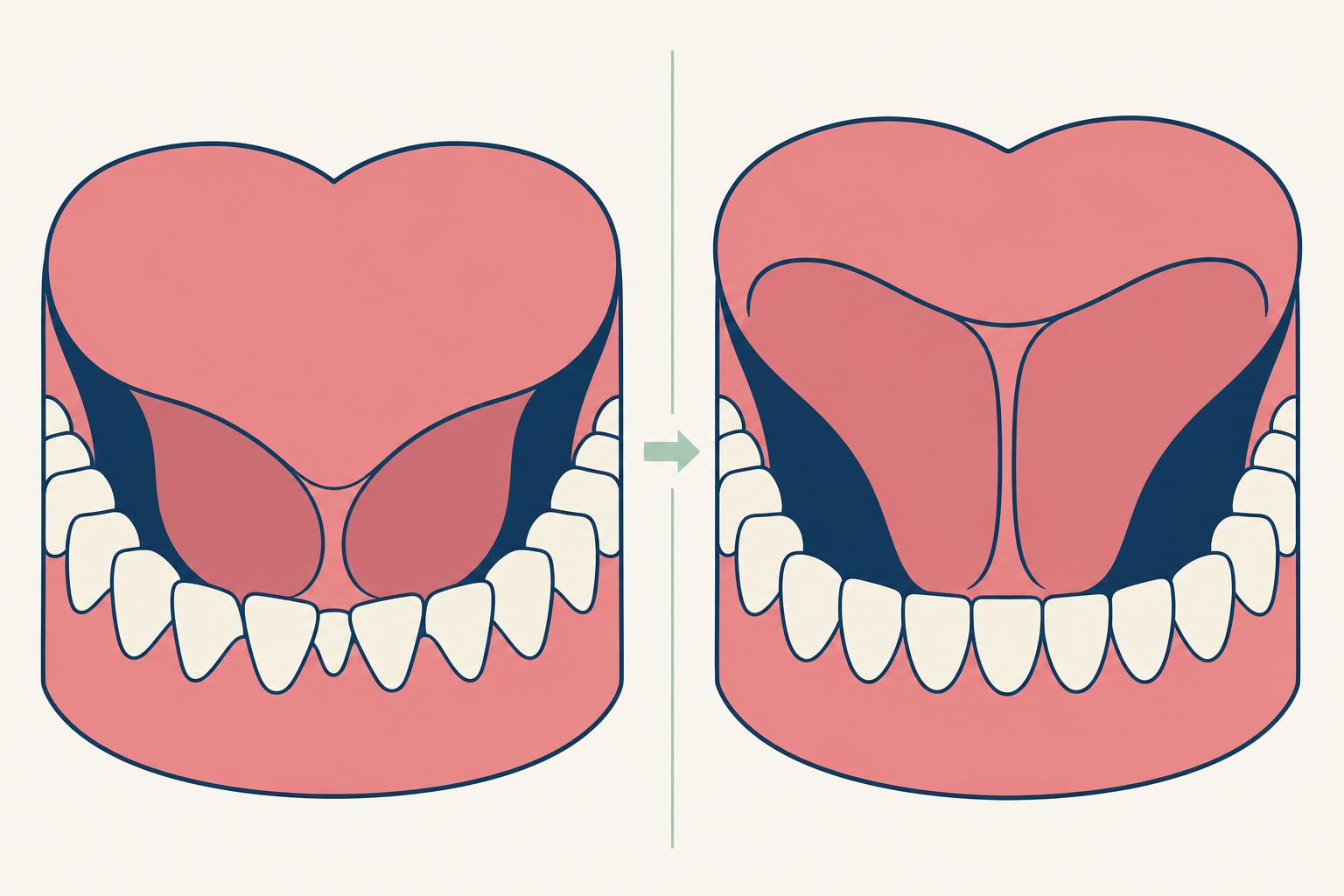 Illustrative diagram: Tongue Tie
