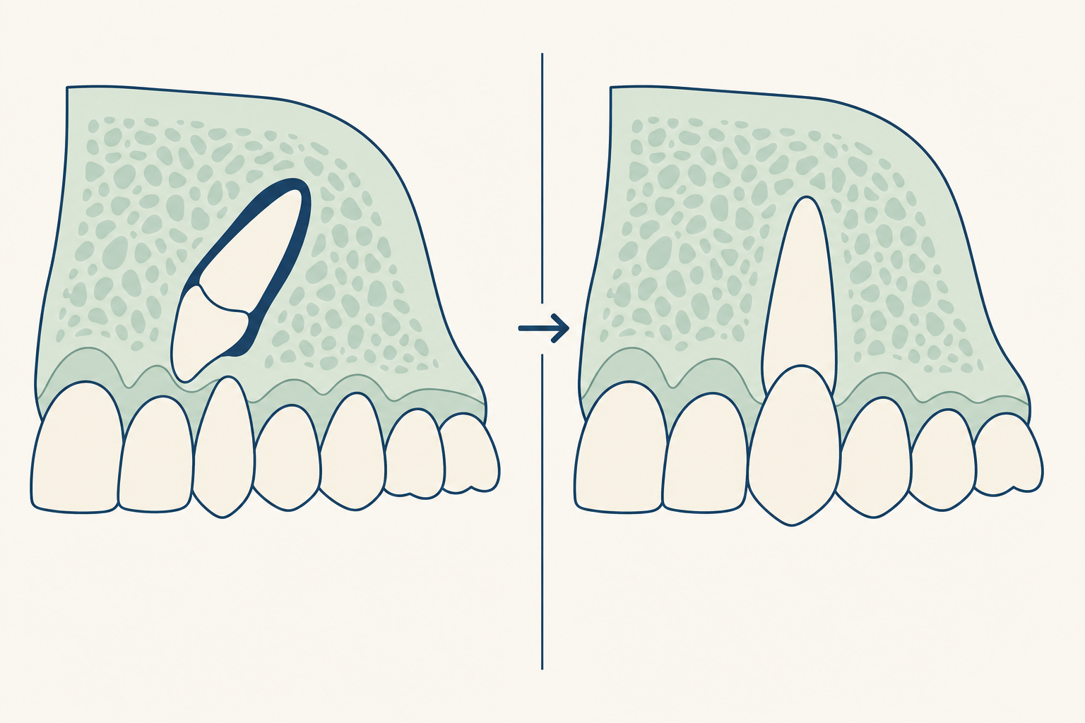 Illustrative diagram: Surgical Exposure of an Impacted Canine