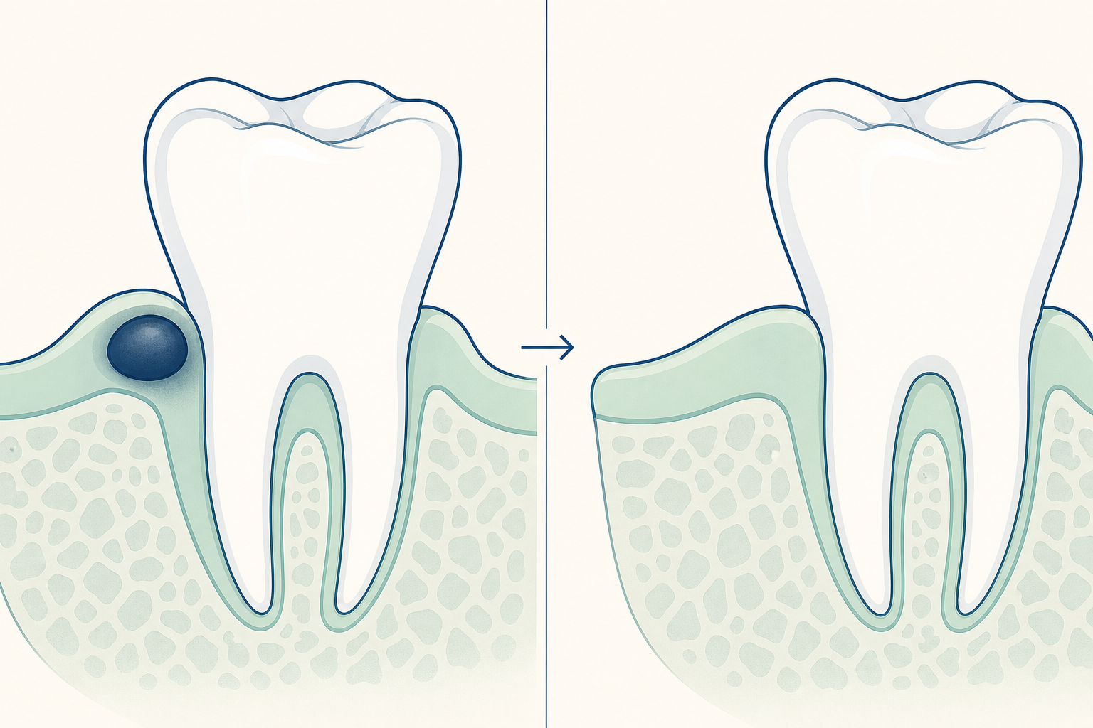 Illustrative diagram: Oral Lesion Removal