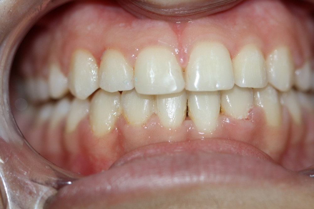 Anterior composite restoration after