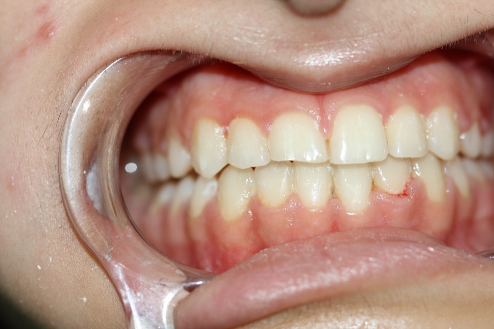Anterior composite restoration before
