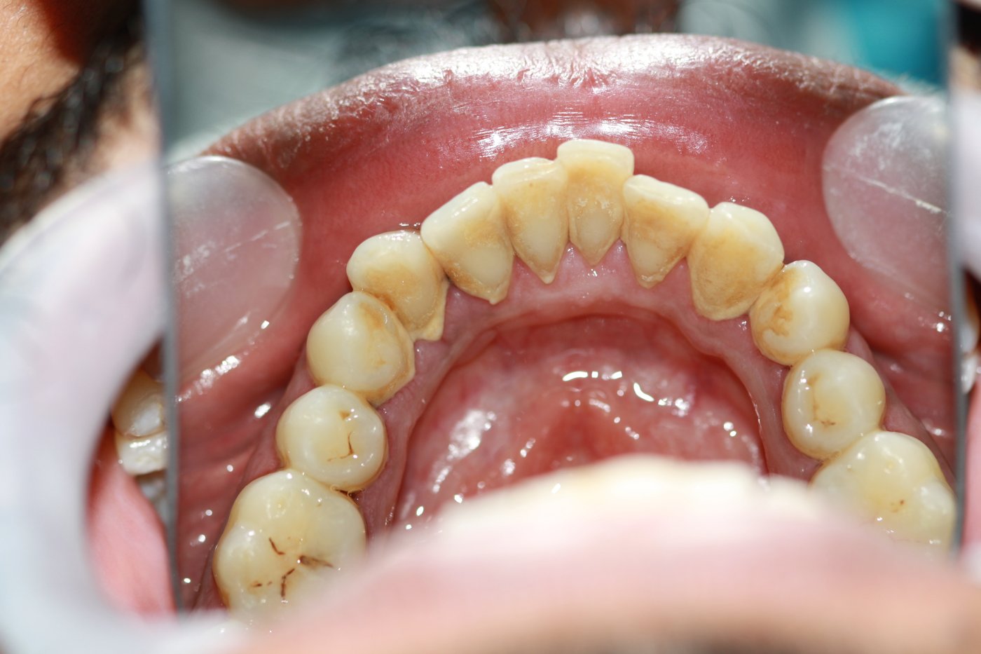 Calculus & stain removal before