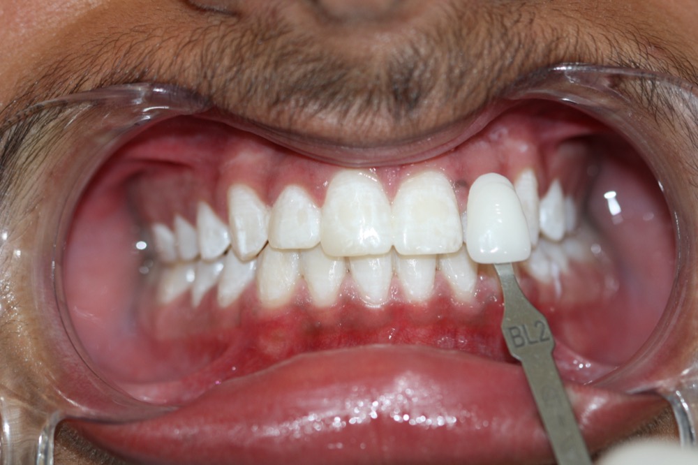 Teeth whitening after