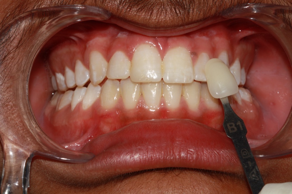 Teeth whitening before
