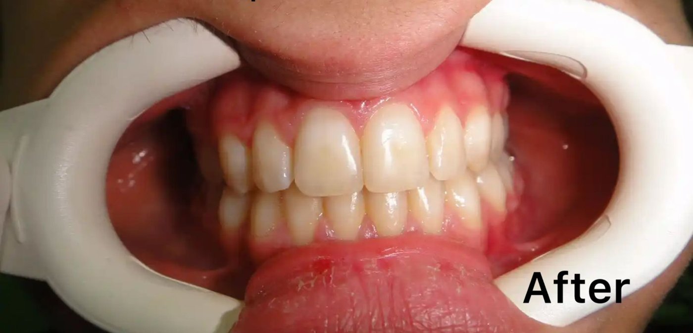 Composite bonding & restoration after